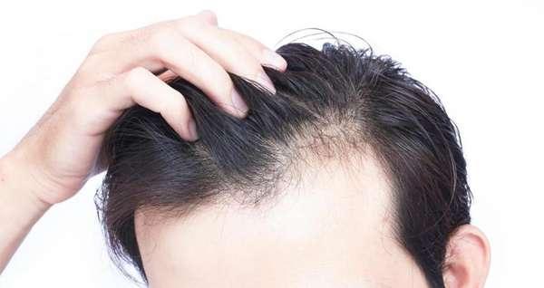 با این 10 روش ساده موی ریخته شده را به سرتان برگردانید با این 10 روش ساده موی ریخته شده را به سرتان برگردانید