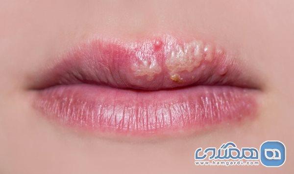 نسخه طب سنتی برای درمان تبخال